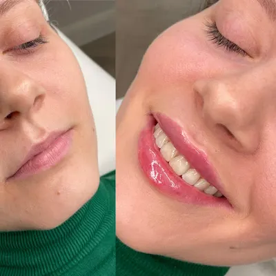 IS Medical Art - Medycyna Estetyczna Poznań - Oczyszczanie Wodorowe, Powiększanie Ust, Botoks